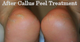 After Callus Peel Treatment