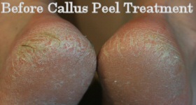 Before Callus Peel Treatment